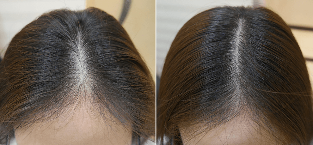 Hair Loss Vs. Hair Thinning.